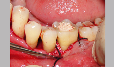 cosmetic dentistry treatment in Anand
                        